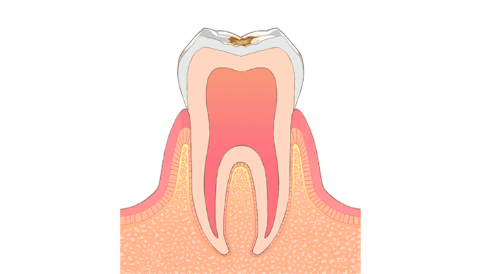 C1：エナメル質内の虫歯